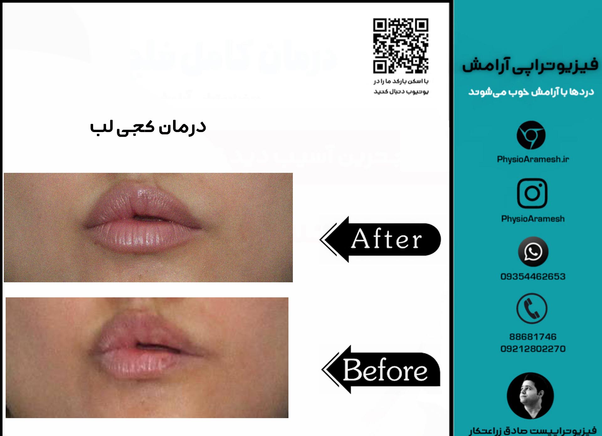 درمان کجی لب